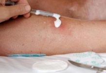 Фурункул на ноге (и между ними): от чего появляется, лечение чирья 5 способами, что делать в домашних условиях