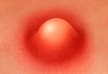 Лечение фурункула: 7 лучших методов в борьбе с чирием