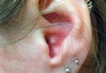 Фурункул в ухе: как выглядит, откуда взялся, как лечить чирей