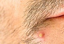 Фурункул: фото, причины и лечение в домашних условиях у взрослых