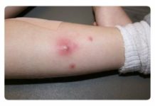 Фурункул на ноге у ребенка: как выглядит чирей на фото, чем лечить у детей?