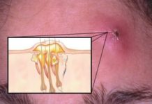 Фурункул заразен или нет: передаётся ли в семье, передача по наследству |