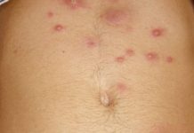 Сыпь во время ОРВИ какие виды и причины бывают