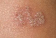 Герпес на попе (ягодицах) — причины и лечение, с фото