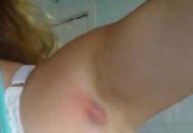 Чем лечить гидраденит под мышкой: фото, лечение и профилактика