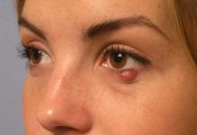 Гнойник на нижнем веке: причины появления, удаление