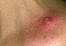 Гнойники на теле: причины, как лечить, разновидности