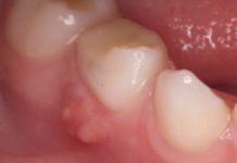 Гнойник на десне (абсцесс): что делать, лечение гнойного нарыва на десне в домашних условиях