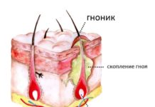 Гнойники на голове в волосах