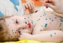 Гнойные прыщи при ветрянке: как выглядят, лечение взрослых и детей