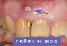 Гнойник на десне (нарыв): причины, лечение, фото