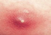 Причины появления гнойных прыщей на лице и их лечение