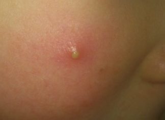 Гнойные прыщики у детей: как лечить, диагностика