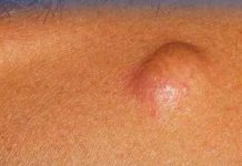 Жировик на шее сзади: причины появления, лечение липом, удаление в домашних условиях |