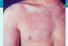 Сыпь при гастрите с повышенной кислотностью