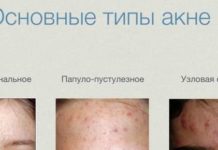 Стадии акне (угревой сыпи) 1, 2, 3, 4 степени тяжести |