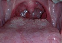 Прыщи на корне языка — что это, причины и лечение