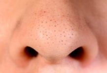 Топ-15 методов как избавиться от черных точек в домашних условиях на разных участках тела реальные отзывы