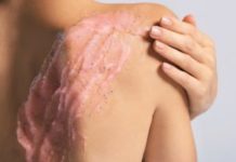 13 ТОП методов как избавиться от черных точек (угрей) на спине и плечах, что делать в домашних условиях