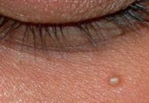 Как избавиться от жировиков