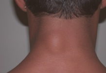 Жировики на теле: по каким причинам они появляются и как от них избавиться