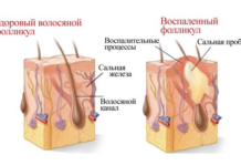 Фурункул: фото, как лечить, причины возникновения