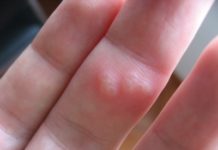 Водянистые пузырьки (прыщи) на пальцах рук