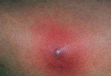 Как отличить прыщ от фурункула? Симптомы, признаки, лечение