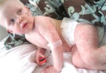 Как выглядит крапивница у ребенка? 20 фото: отличительные признаки на начальной стадии