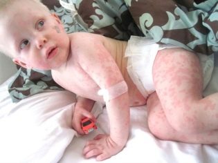 Аллергия у ребенка как ожоги от крапивы thumbnail