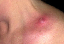 Как вылечить чирей в домашних условиях быстро на попе, ноге, лице, глазу, в паху, под мышкой