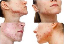 Как вылечить прыщи на лице — советы дерматологов и косметологов