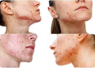 Как вылечить прыщи на лице — советы дерматологов и косметологов
