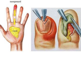 Какие мази вытягивают гной — как правильно использовать