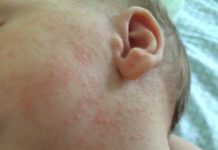 Гормональные высыпания на личике у младенцев: как вглядят прыщи, когда проходят