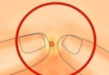 Как выдавить чирей правильно, последствия, народная медицина |