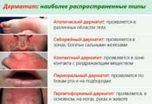 Кожные высыпания