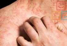 Сыпь на нервной почве: симптомы, виды и фото нервных высыпаний