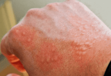 Водянистые прыщи на теле, фото с пояснениями