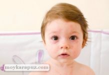 Крапивница у ребенка