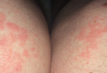 Сыпь на коленях: фото, возможные причины, лечение | Заболевания кожи