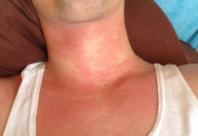 Сыпь на шее: фото, возможные болезни, лечение