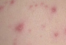 Сыпь на теле у взрослого: как лечить, если чешется, красные высыпания по всему телу и аллергия