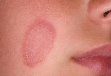 Красные пятна на коже у взрослых и детей — виды высыпаний и их фото, аллергия с зудом и без