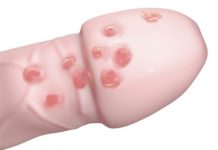 Красные прыщи на головке у мужчин — все причины и фото