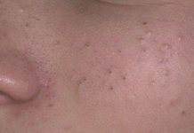 Черные точки на лице у грудничка |