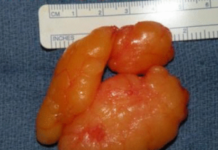 Липома: может ли перерасти в рак?