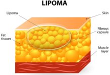 Липома МКБ 10 код по международной классификации