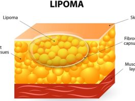 Липома МКБ 10 код по международной классификации