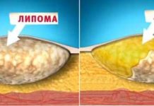 Липома, что это такое, фото как выглядит на спине, на голове, лечение